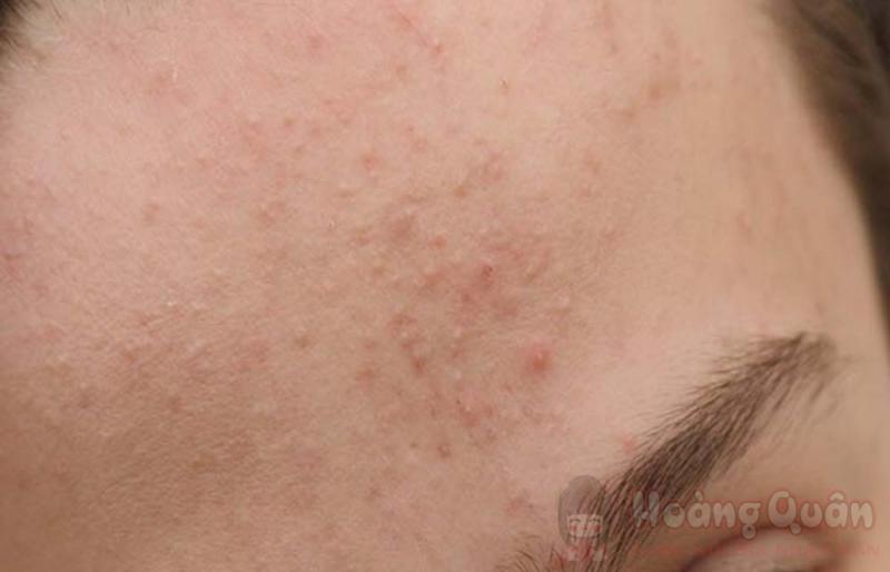 peel da xong bị mụn peel da xong bị mụn