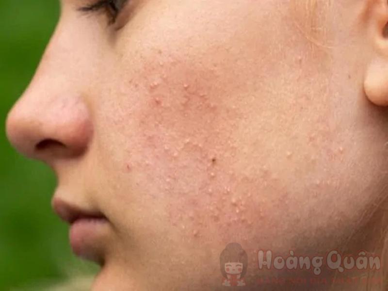 peel da lên mụn peel da lên mụn
