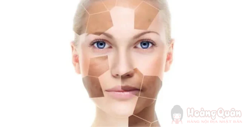 da bị tăng sắc tố sau peel da bị tăng sắc tố sau peel