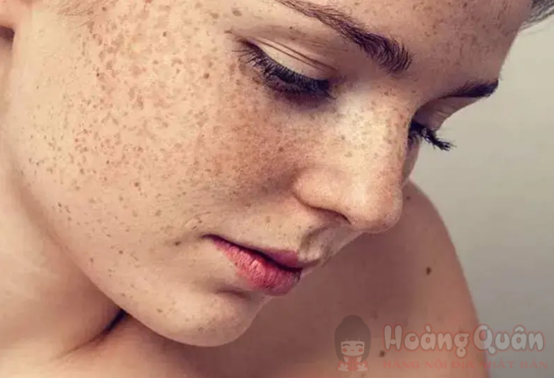 nguyên nhân da bị tăng sắc tố sau peel nguyên nhân da bị tăng sắc tố sau peel