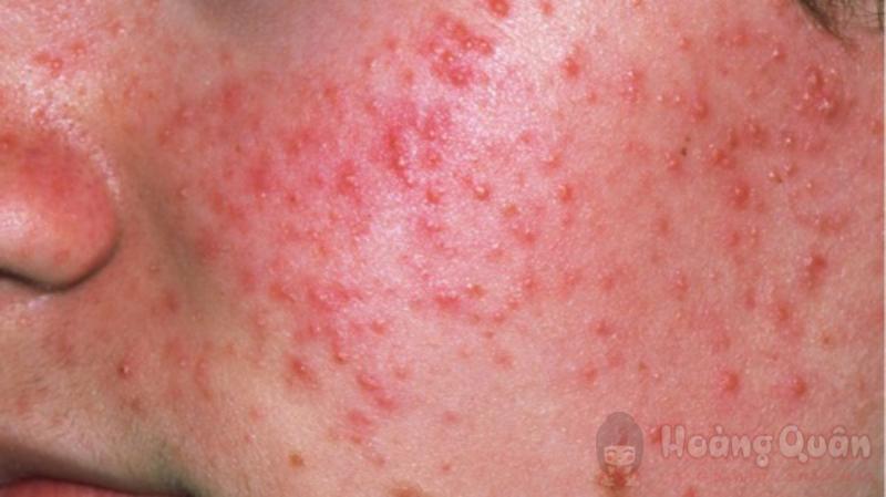 tìm hiểu peel da nhiều có tốt không