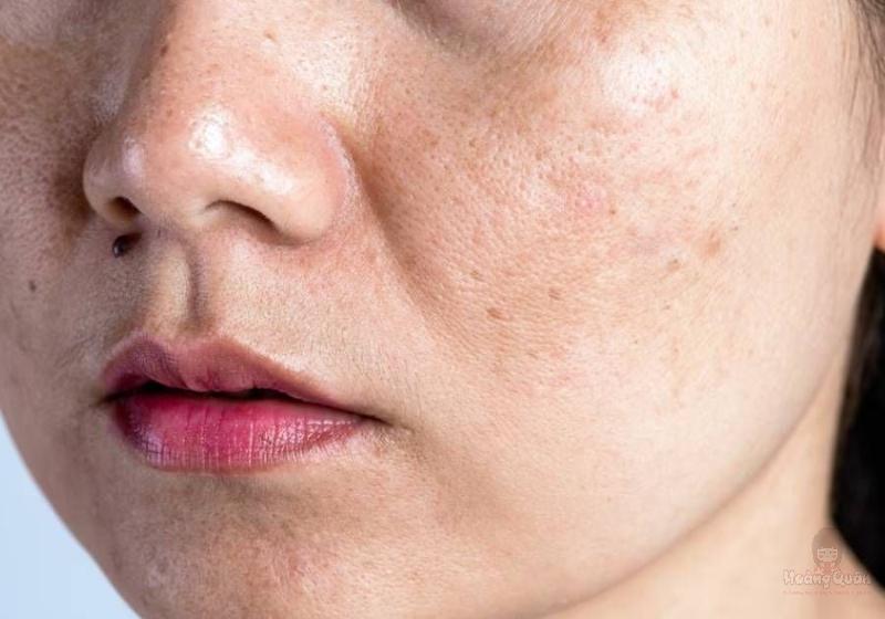 những tác hại của việc không dùng kem chống nắng